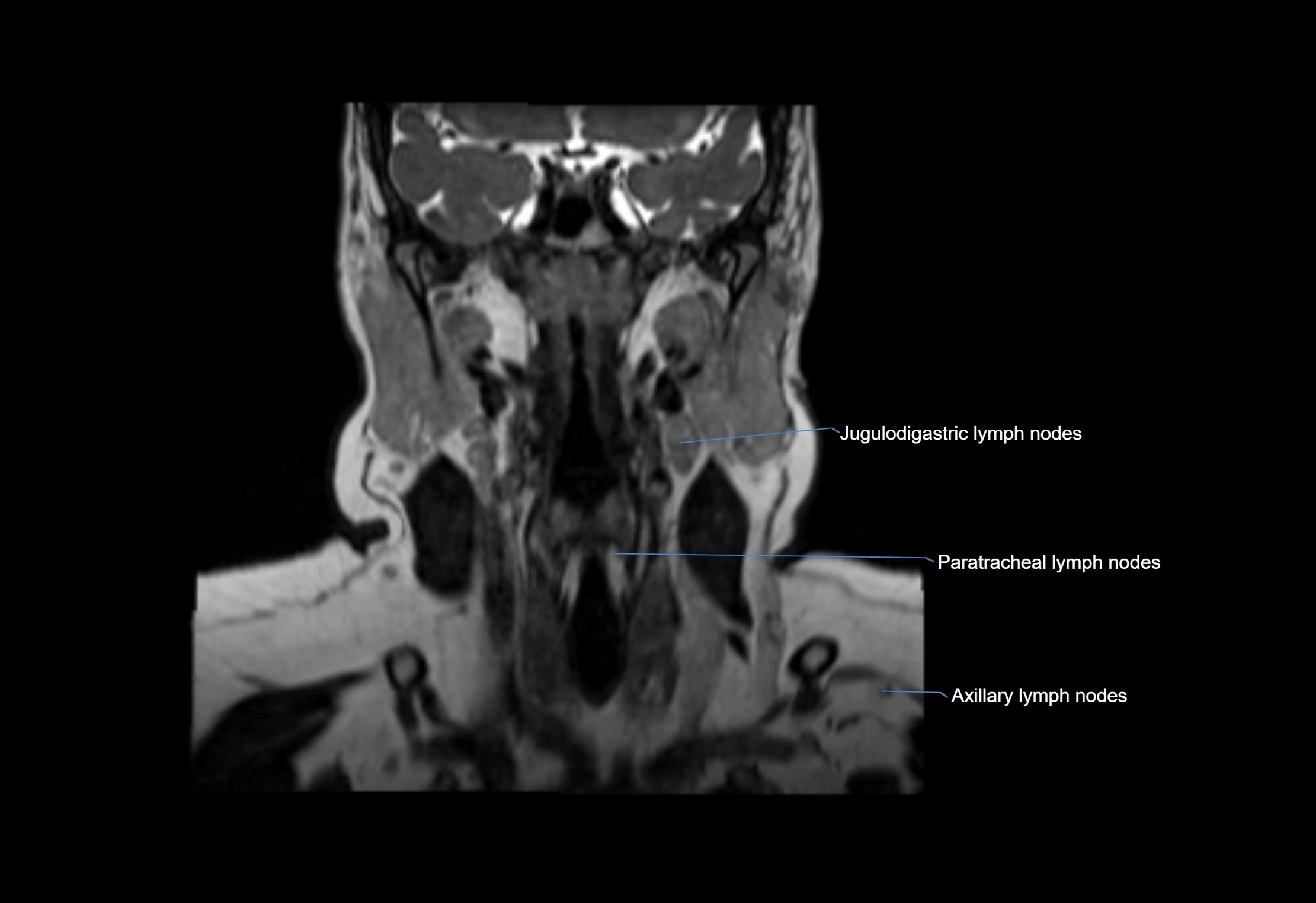 Neck coronal lymph node cross sectional MRI anatomy 3T MRI  image-img-00001-00040.webp